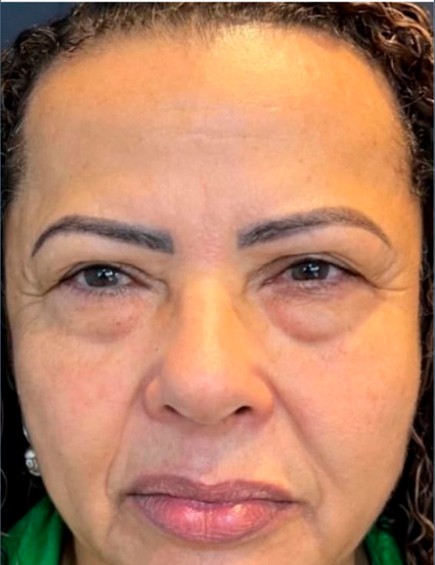 Antes da Blefaroplastia Inferior
