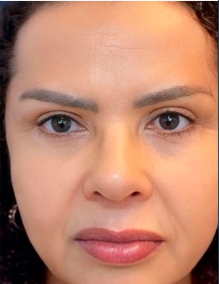 Depois da Blefaroplastia Inferior