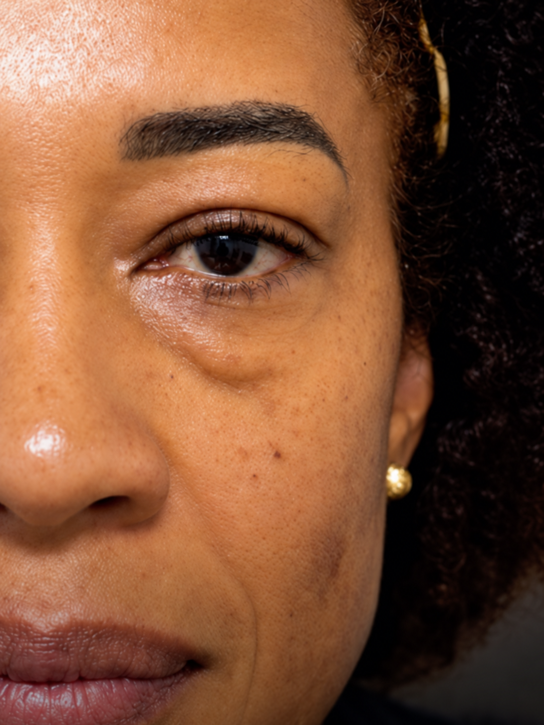 Análise integrada da pálpebra superior, inferior e dinâmica facial